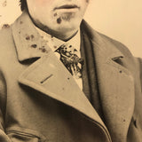 Man with Lost Eye, Pink Cheeks, Voluminous Coat, 19th C. Full Plate Tintype